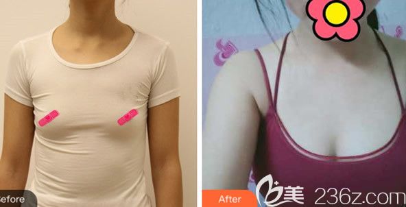 水滴形曼托假體隆胸前后效果對(duì)比照片 水滴形曼托假體隆胸前后效果對(duì)比照片