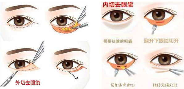 內(nèi)切去眼袋和外切祛眼袋手術(shù)方法區(qū)別