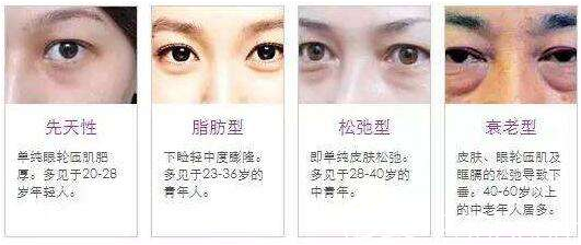 各種類型的眼袋示意圖