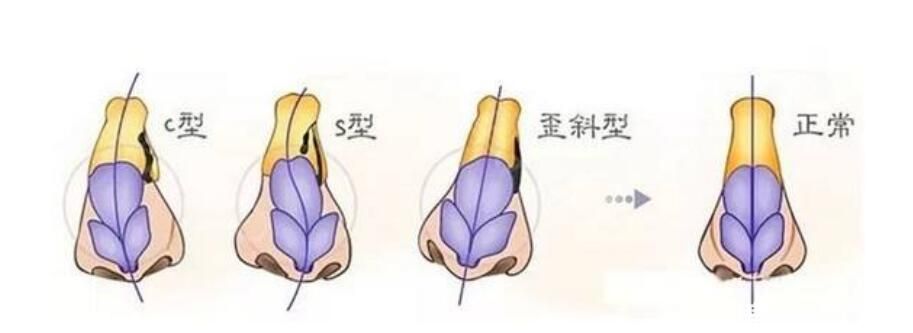 隆鼻假體下滑表現(xiàn)現(xiàn)象