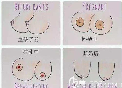 女性生產(chǎn)完后胸部扁平下垂