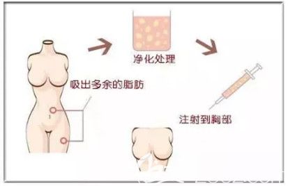 產(chǎn)后胸部干癟采用自體脂肪豐胸手術(shù)恢復(fù)豐滿胸部