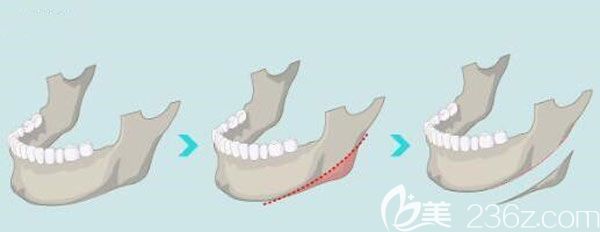 下頜角手術(shù)截骨示意圖 下頜角手術(shù)截骨示意圖