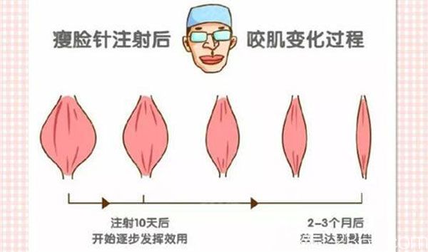 國(guó)字臉打瘦臉有效果嗎 國(guó)字臉打瘦臉有效果嗎