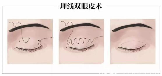 埋線雙眼皮手術(shù)步驟