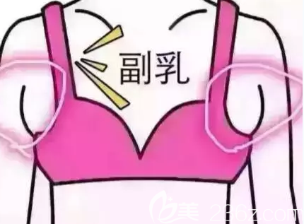 副乳示意圖
