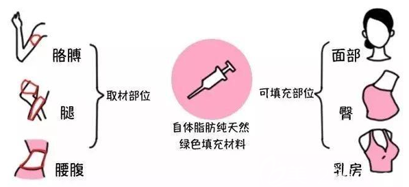 自體脂肪抽取部位及可填充部位