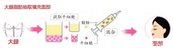 大腿抽脂填充臉部手術(shù)過程示意圖