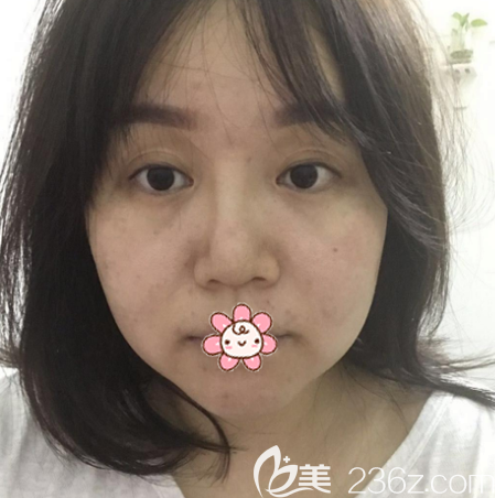 在廣州軍美做面部吸脂術(shù)前照片 在廣州軍美做面部吸脂術(shù)前照片