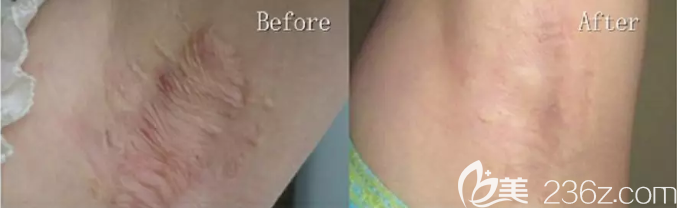 手術(shù)疤痕治療效果