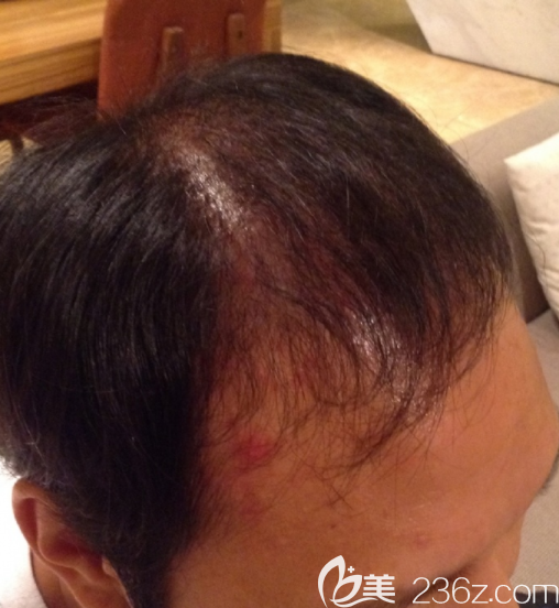 韓國JP做毛發(fā)移植怎么樣 韓國JP做毛發(fā)移植怎么樣