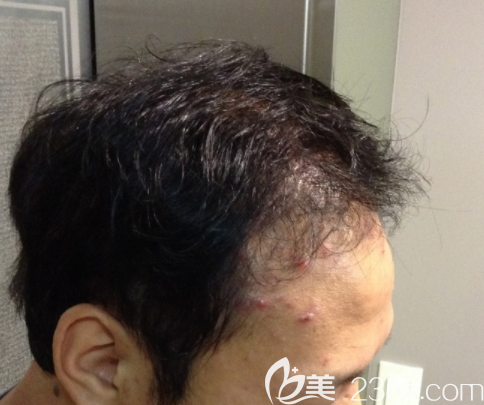 韓國JP崔鐘弼毛發(fā)移植怎么樣 韓國JP崔鐘弼毛發(fā)移植怎么樣