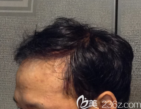 韓國JP崔鐘弼毛發(fā)移植4800毛6個(gè)月頭發(fā)慢慢變密心情也也逐漸變好