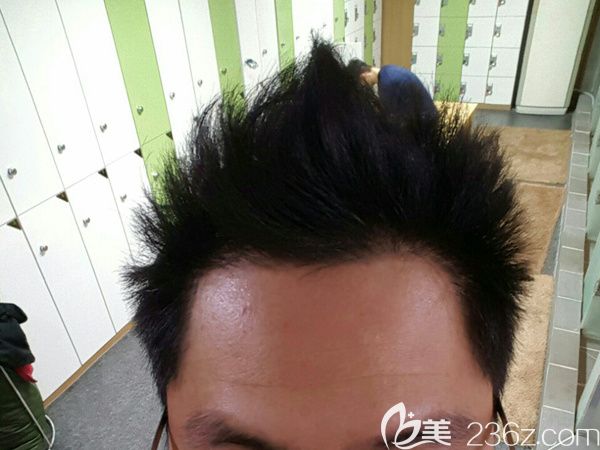 韓國jp非切開發(fā)際線+頭頂移植3500根1年后很滿意謝謝JP