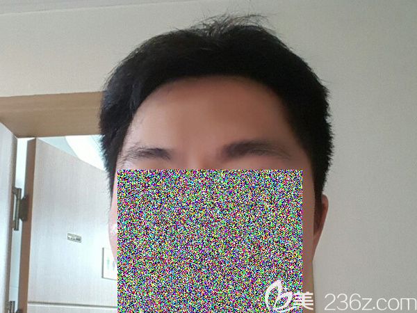 韓國(guó)jp毛發(fā)移植真人案例