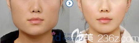 磨腮削骨手術(shù)對(duì)比效果圖 磨腮削骨手術(shù)對(duì)比效果圖