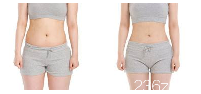 腰腹環(huán)吸案例前后對(duì)比圖