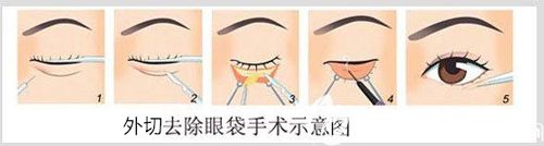 外切法去眼袋手術(shù)過程示意圖