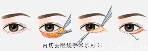 內(nèi)切去眼袋手術(shù)步驟簡易圖