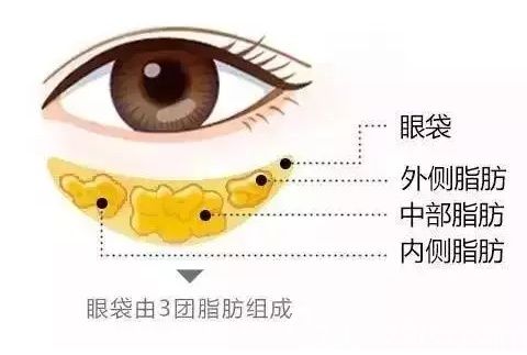 形成眼袋的3團(tuán)脂肪分布位置