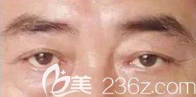 男士眼睛出現(xiàn)眼袋的情況