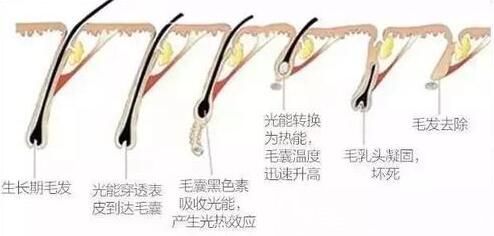 激光脫絡(luò)腮胡原理