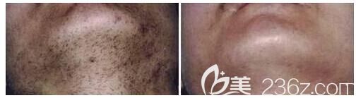 激光去胡須前后對(duì)比案例
