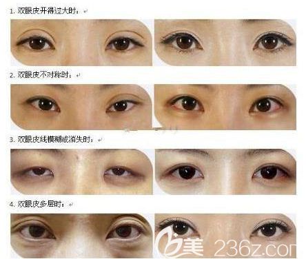 雙眼皮失敗原因和效果