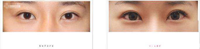 雙眼皮修復(fù)效果對(duì)比圖