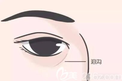 什么是淚溝 什么是淚溝