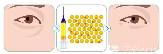 自體脂肪填充淚溝原理 自體脂肪填充淚溝原理