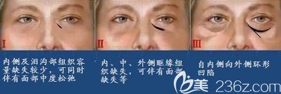 淚溝的<span style= 淚溝的<span style=