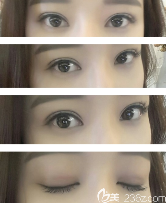 奧斯卡歐式雙眼皮真人案例 奧斯卡歐式雙眼皮真人案例