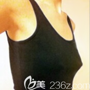 豐胸術前面對自己的小胸有點自卑 豐胸術前面對自己的小胸有點自卑
