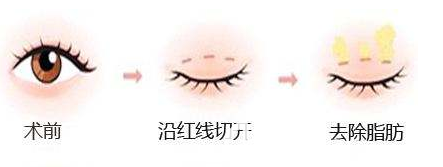 全切雙眼皮的示意圖