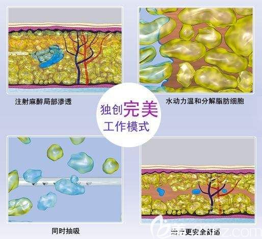 水動(dòng)力吸脂原理圖