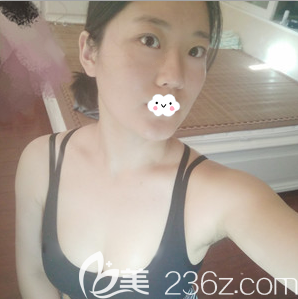 成美賴明忠自體脂肪豐胸術后半年照 成美賴明忠自體脂肪豐胸術后半年照