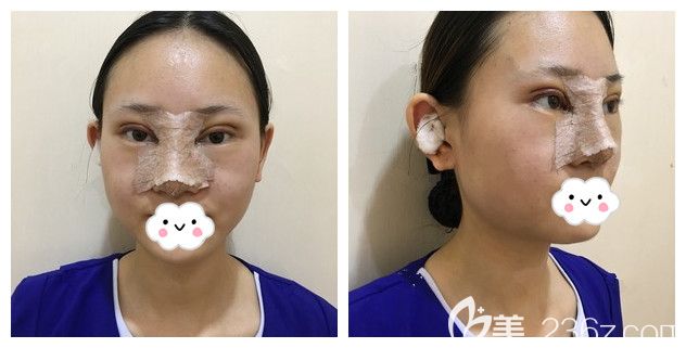 冰敷兩天后眼鼻恢復(fù)情況