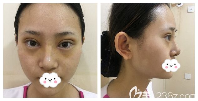 一周拆線眼鼻恢復(fù)情況