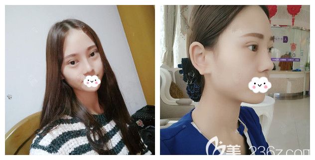 做完硅膠+自體耳軟骨隆鼻+翹睫美瞳雙眼皮術(shù)后半個月恢復(fù)