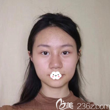 在廣州軍美做面部吸脂術(shù)前照片 在廣州軍美做面部吸脂術(shù)前照片