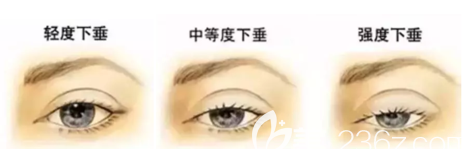 上瞼下垂不同程度展示圖