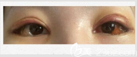 韓國(guó)Gio眼角真人案例 韓國(guó)Gio眼角真人案例