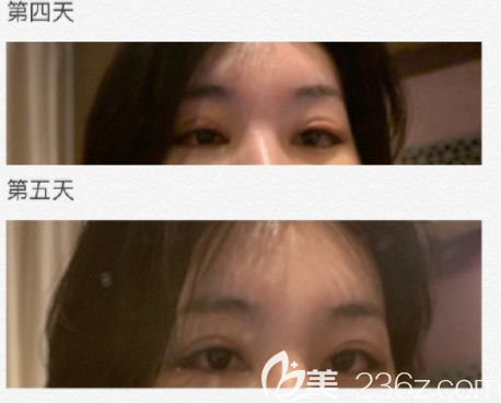 韓國(guó)Gio做眼睛怎么樣 韓國(guó)Gio做眼睛怎么樣