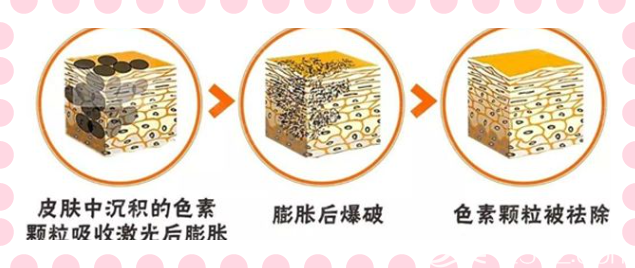 激光祛斑后反黑圖解