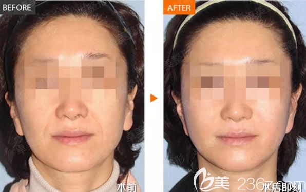 玻尿酸填充法令紋效果