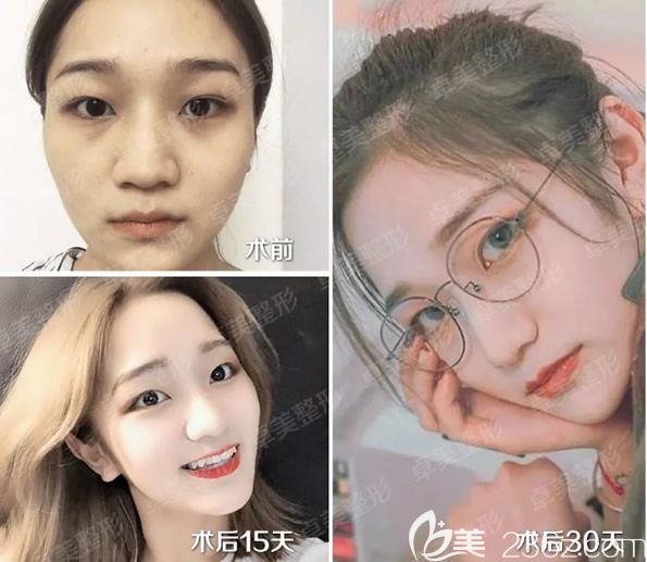 真人全臉脂肪填充前后效果對(duì)比照片