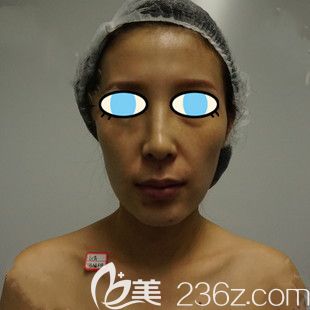 南陽維多利亞面部填充術(shù)前 南陽維多利亞面部填充術(shù)前