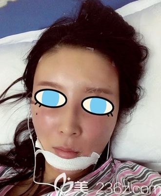 南陽維多利亞面部填充術(shù)后即刻 南陽維多利亞面部填充術(shù)后即刻