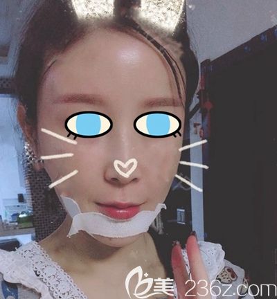 南陽維多利亞面部填充術(shù)后第3天 南陽維多利亞面部填充術(shù)后第3天